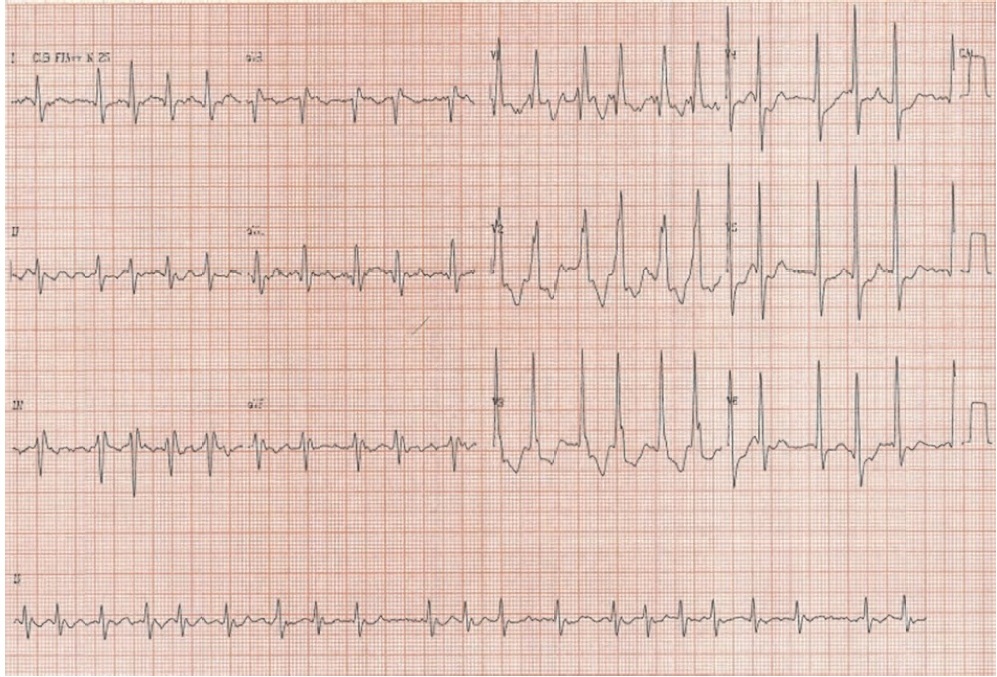 Ecg rev 13 q42